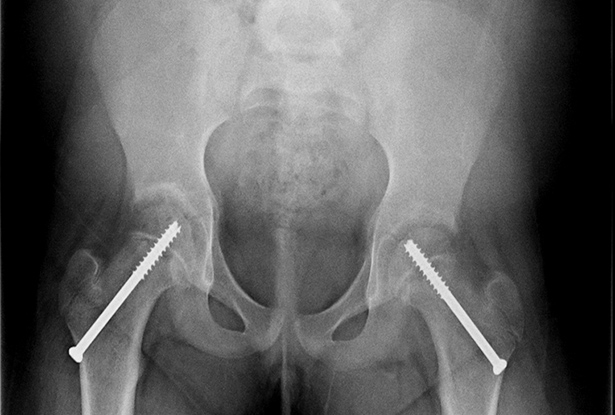 X-ray after treatment